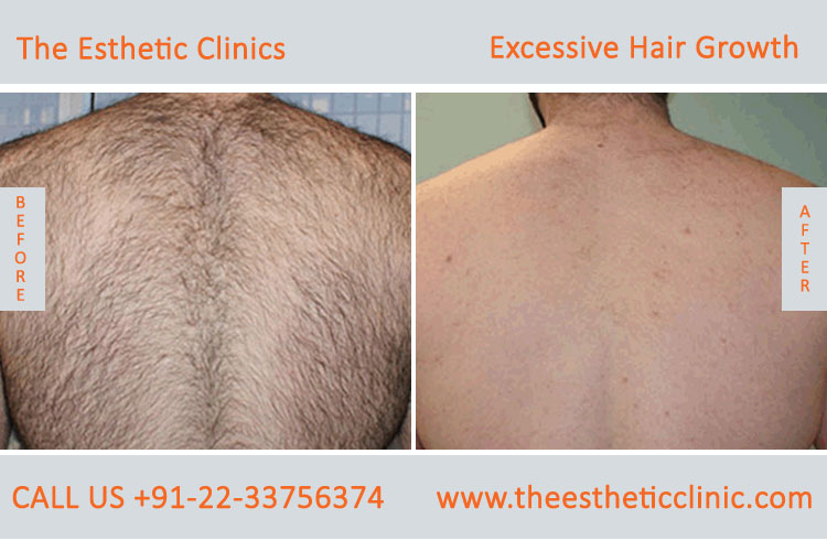Excessive Hair Growth Removal Treatment before after photos in mumbai india (1)